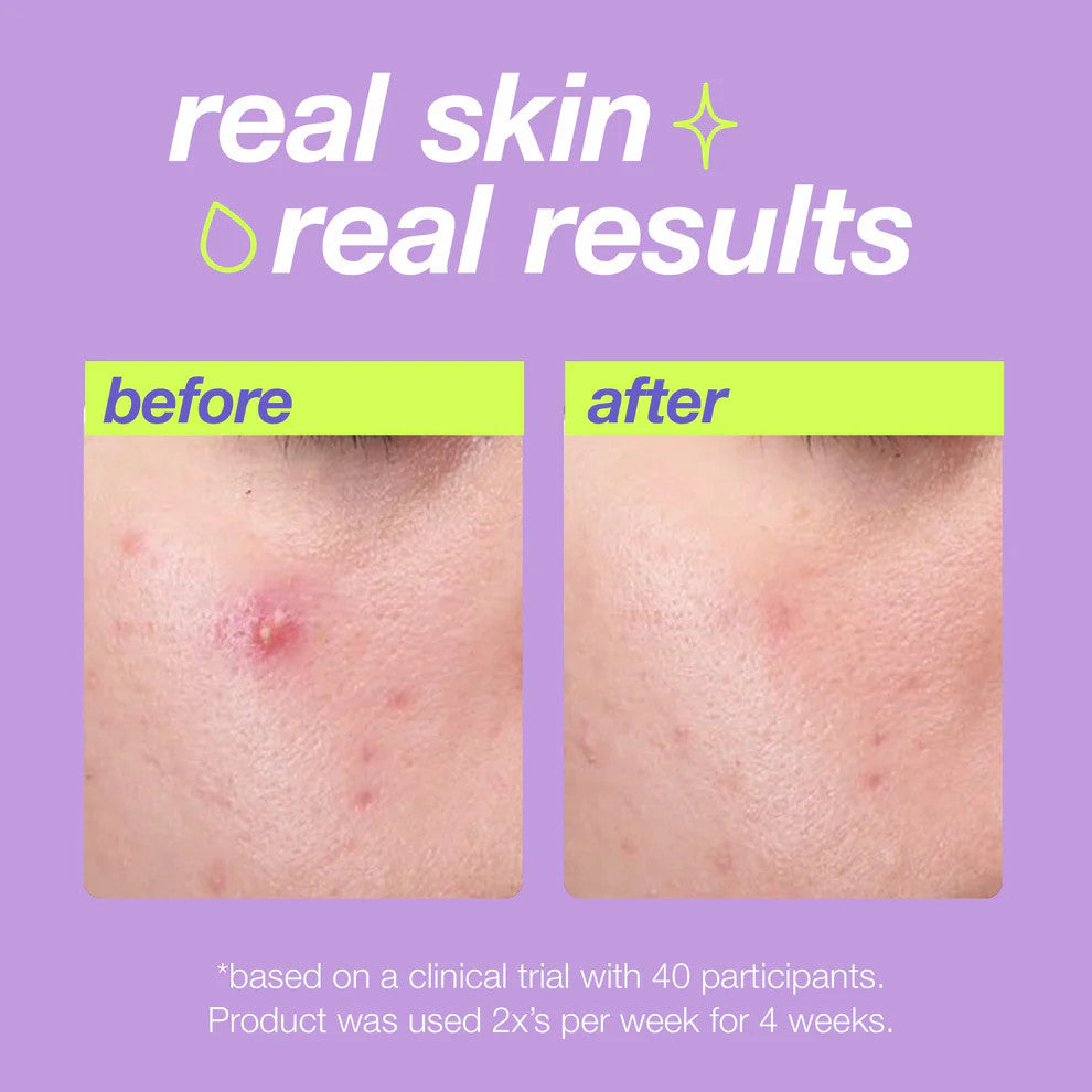 breakout clearing liquid peel