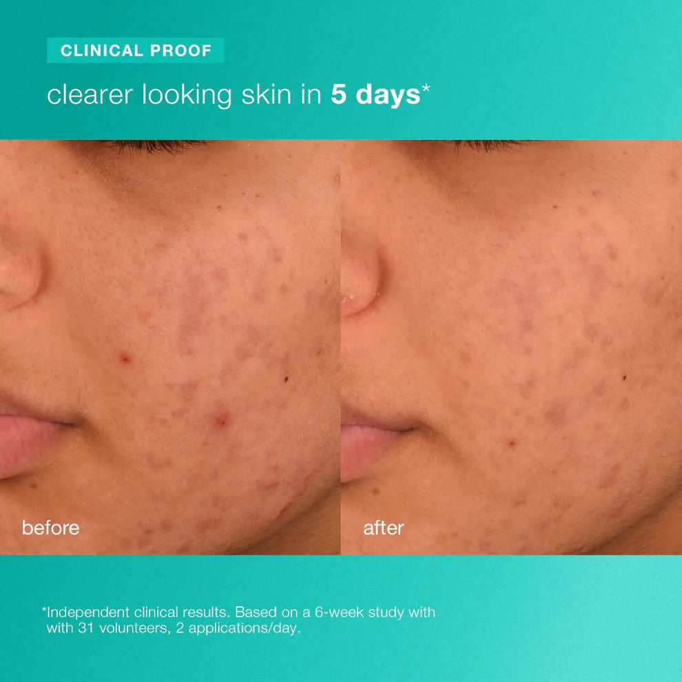 acne biotic moisturizer