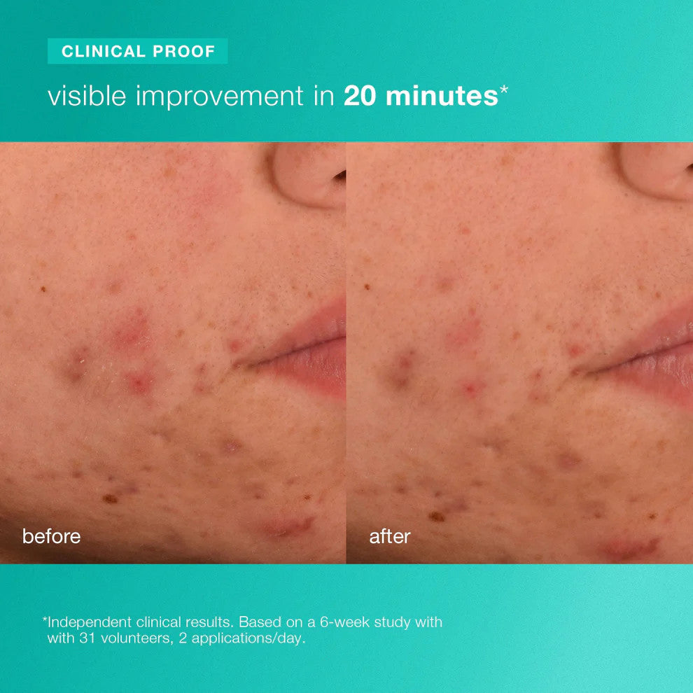 acne biotic moisturizer